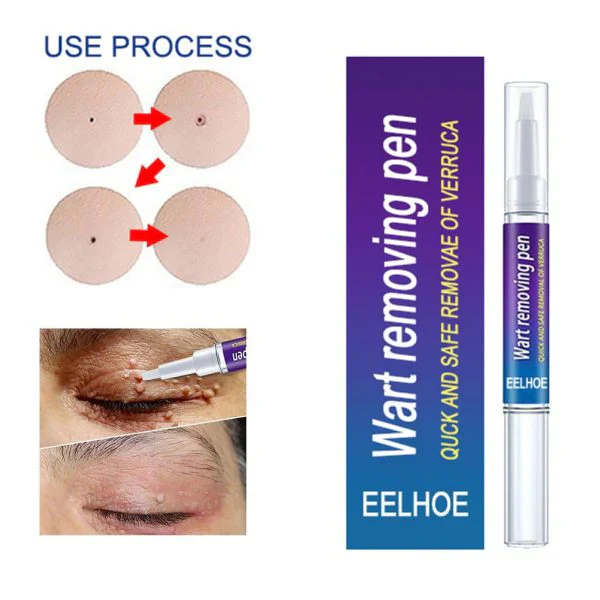 Warts Remover Original Cream – Fast & Gentle Wart Removal Treatment